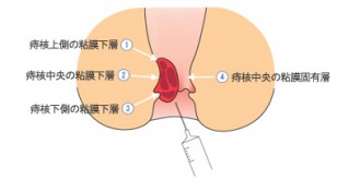 四段階注射法のイメージ